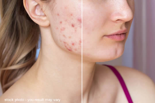 before and after acne treatment of woman's face close up  