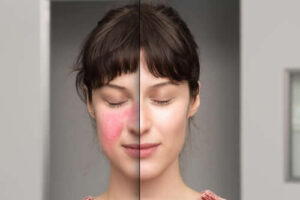 rosacea before after treatment on face
