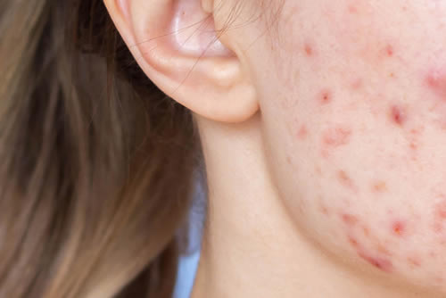 Severe acne on young woman's face