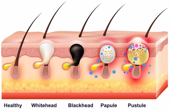 Different types of acne pimples