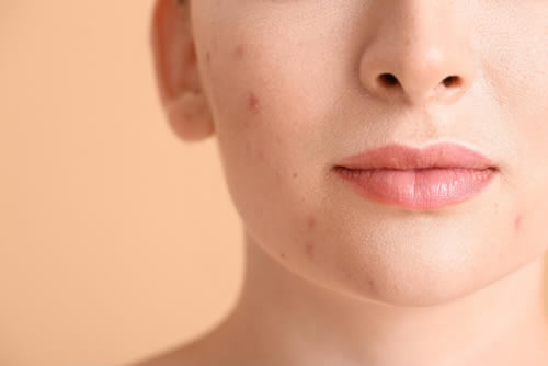 young woman with mild acne on face
